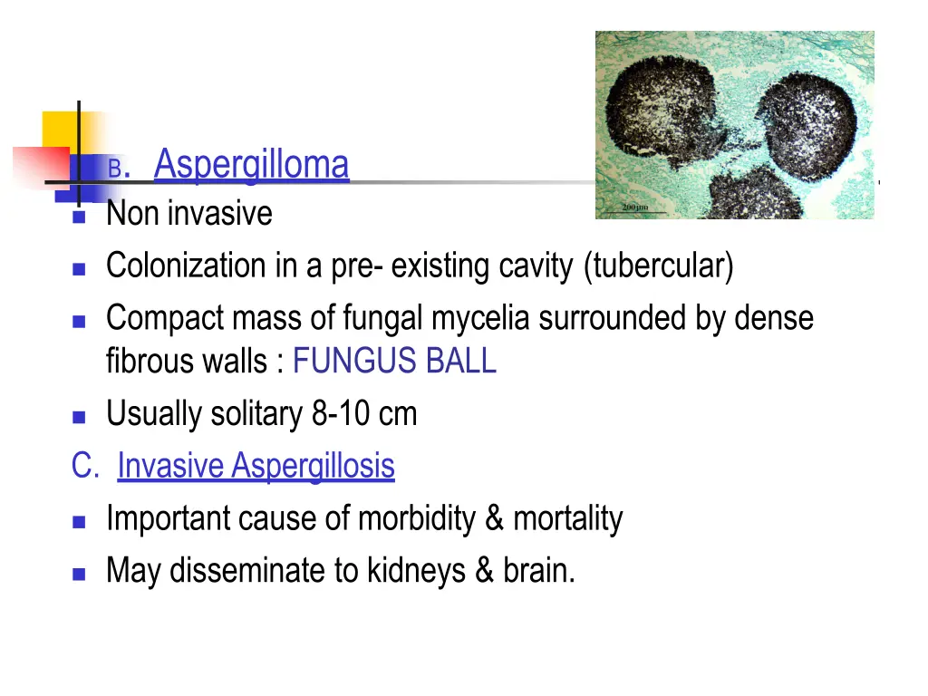 b aspergilloma noninvasive