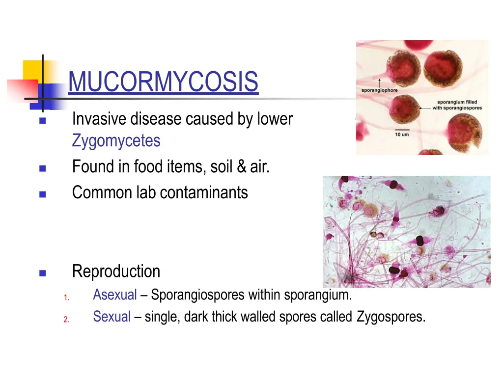 mucormycosis