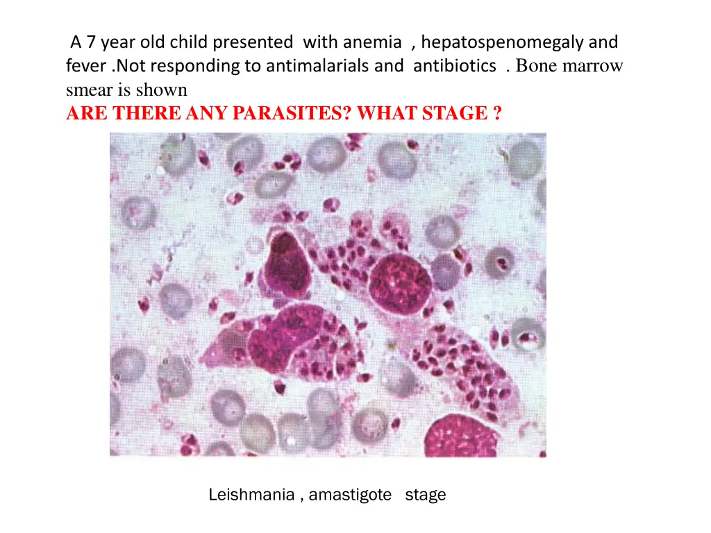 a 7 year old child presented with anemia