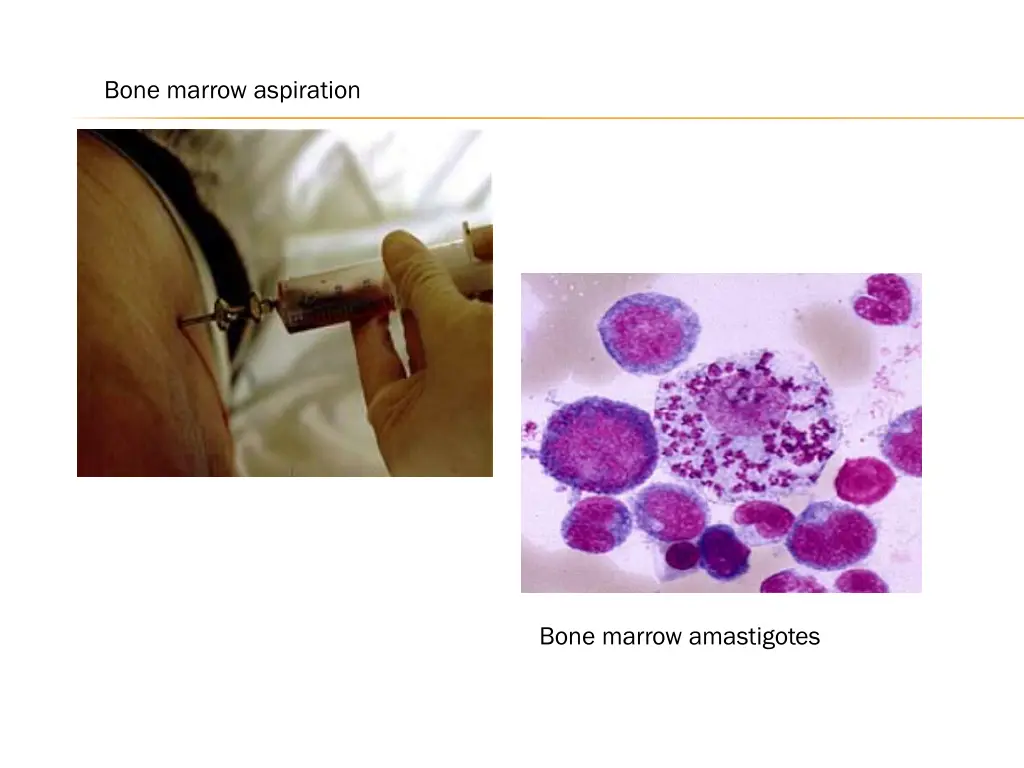 bone marrow aspiration