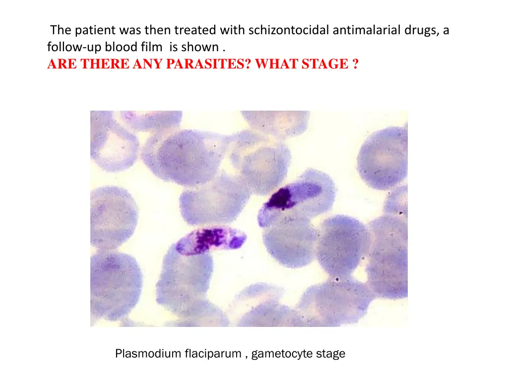 the patient was then treated with schizontocidal