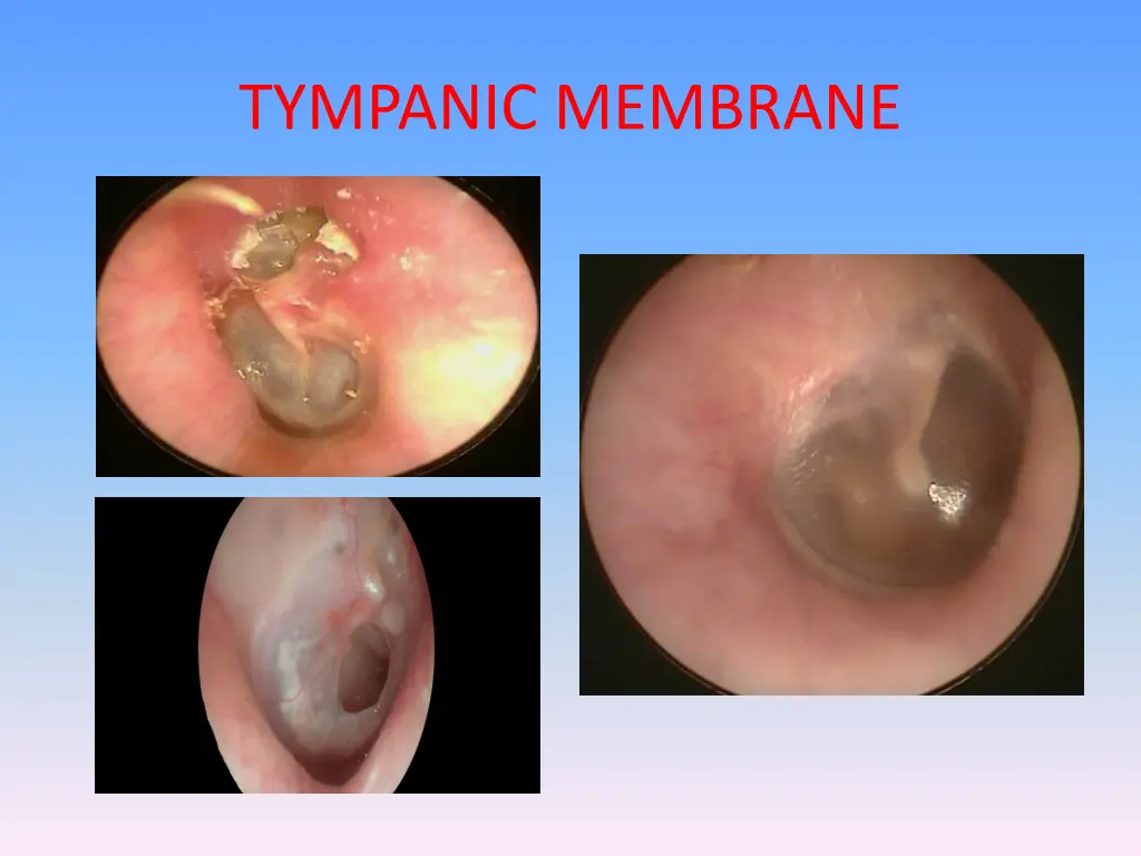 tympanic membrane 3