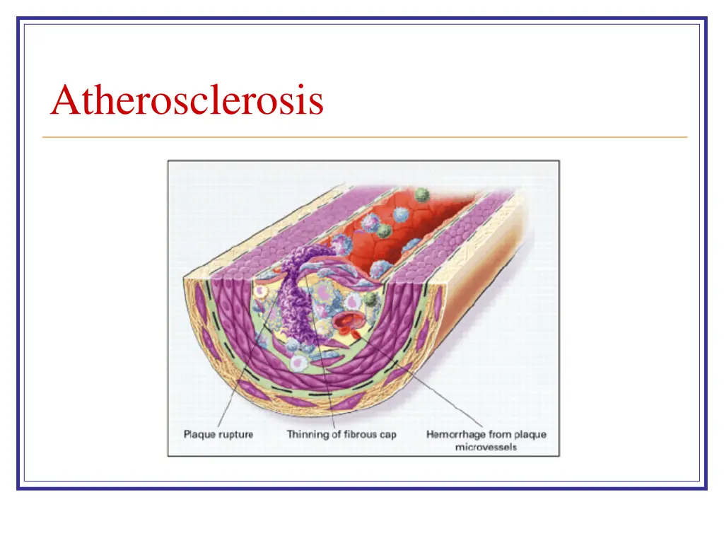 atherosclerosis