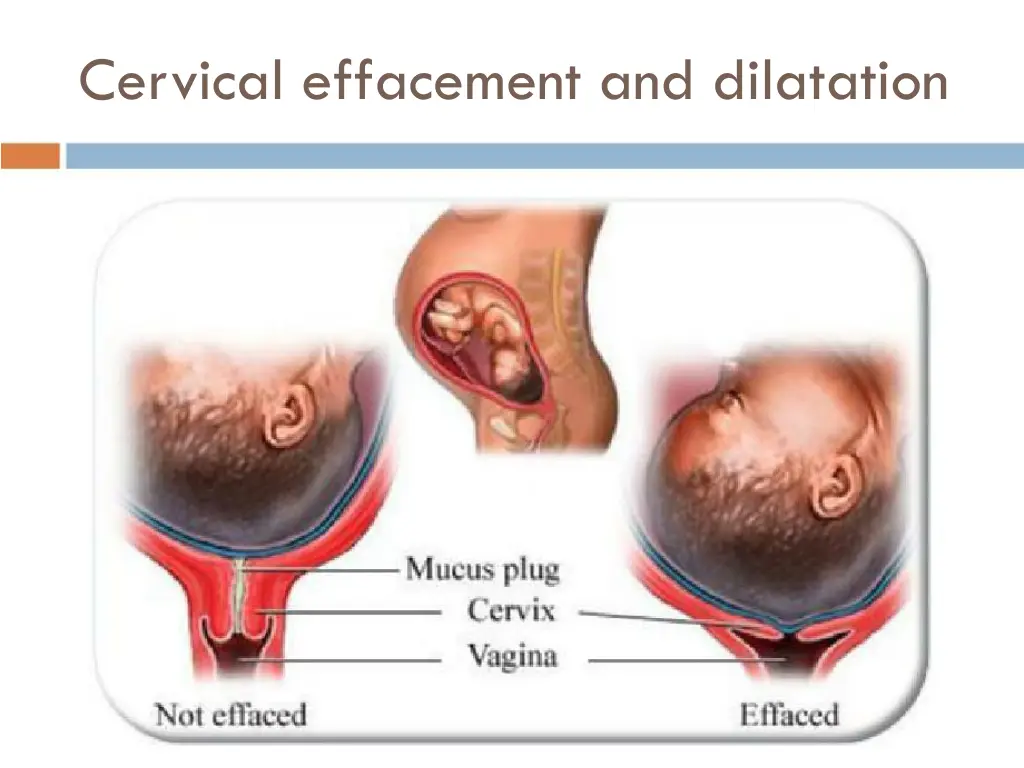 cervical effacement and dilatation