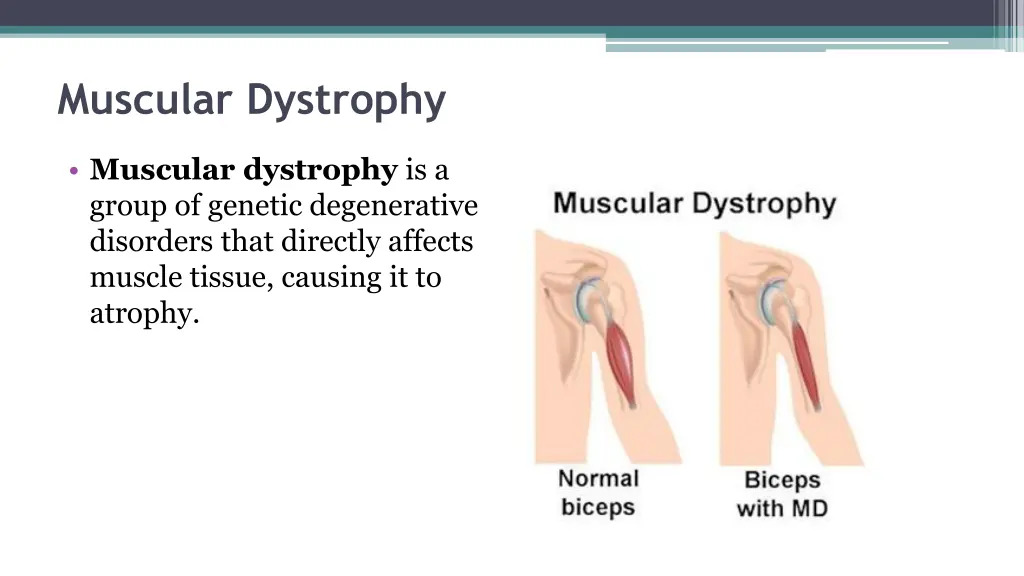 muscular dystrophy