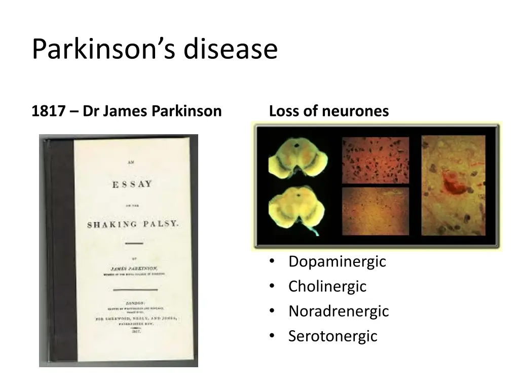 parkinson s disease 1