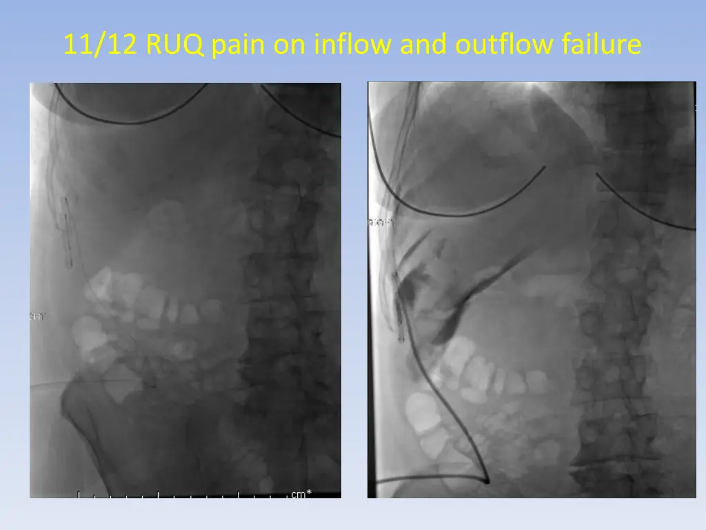 11 12 ruq pain on inflow and outflow failure