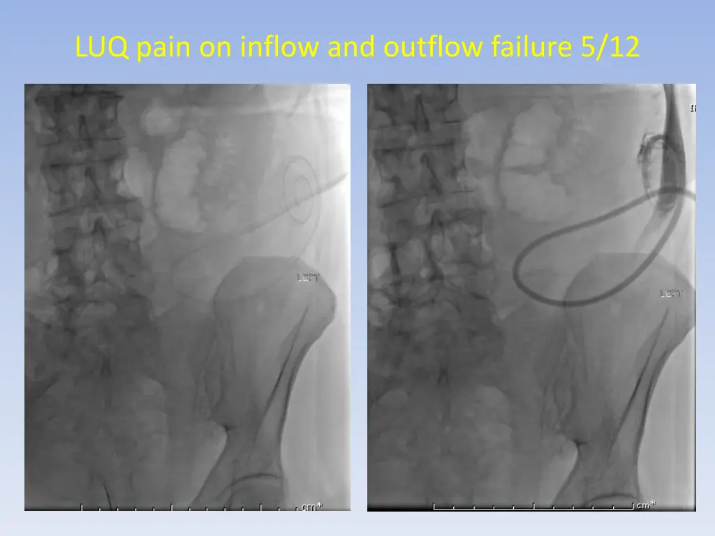 luq pain on inflow and outflow failure 5 12