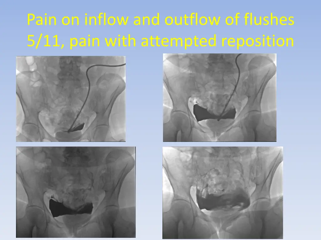 pain on inflow and outflow of flushes 5 11 pain