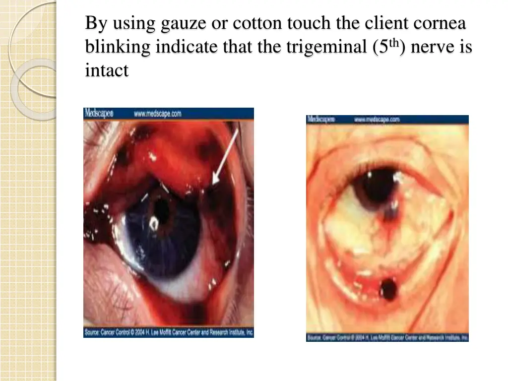 by using gauze or cotton touch the client cornea