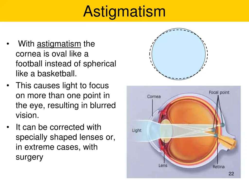 astigmatism