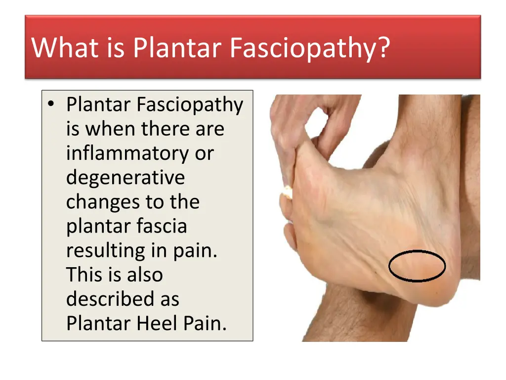 what is plantar fasciopathy