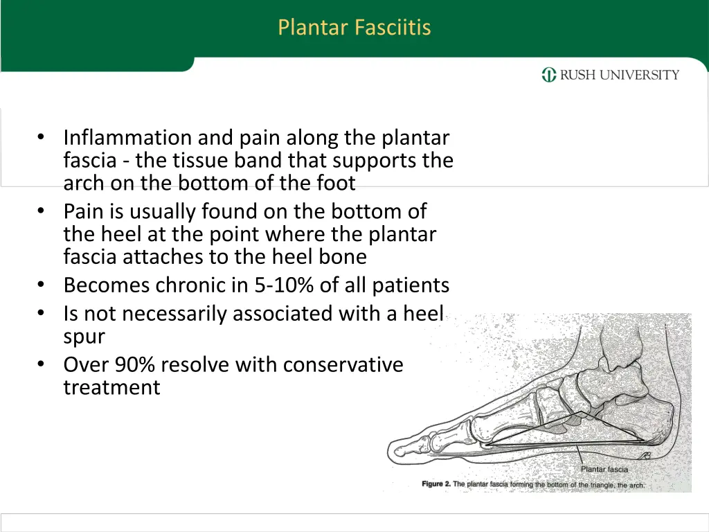 plantar fasciitis 1