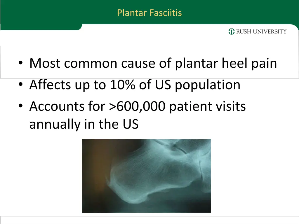 plantar fasciitis