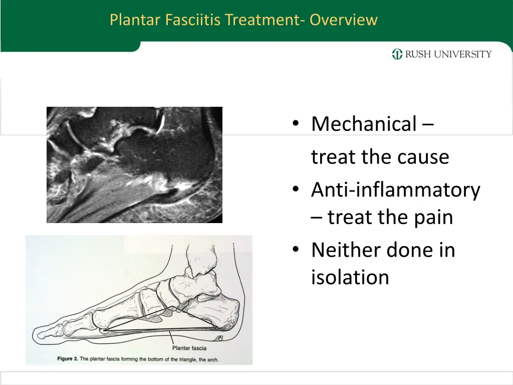 plantar fasciitis treatment overview