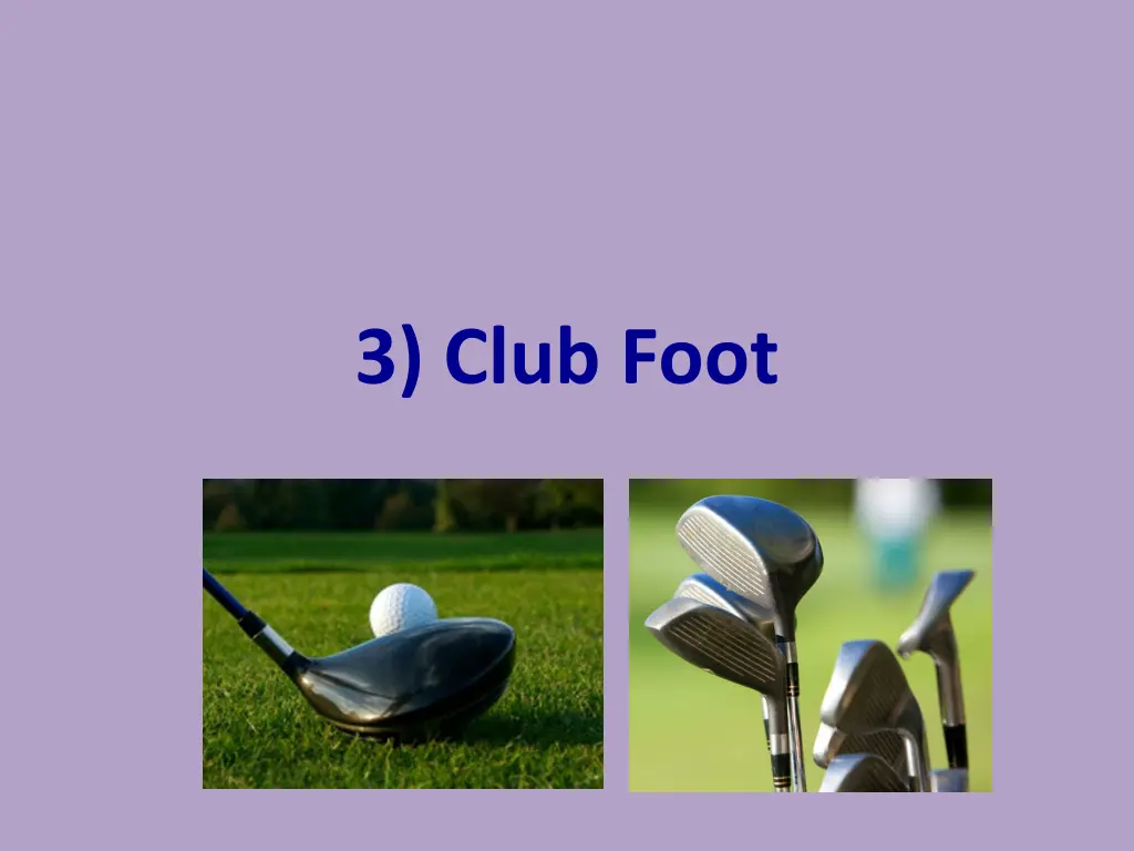 3 club foot