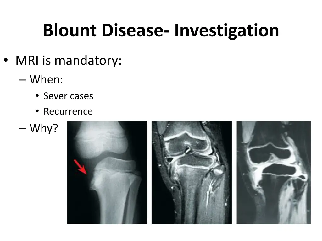 blount disease investigation