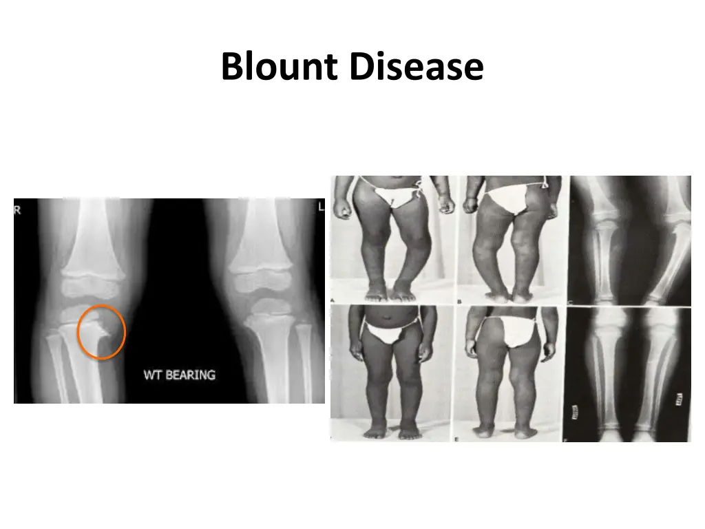 blount disease