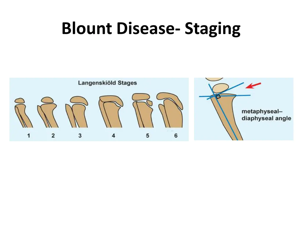 blount disease staging