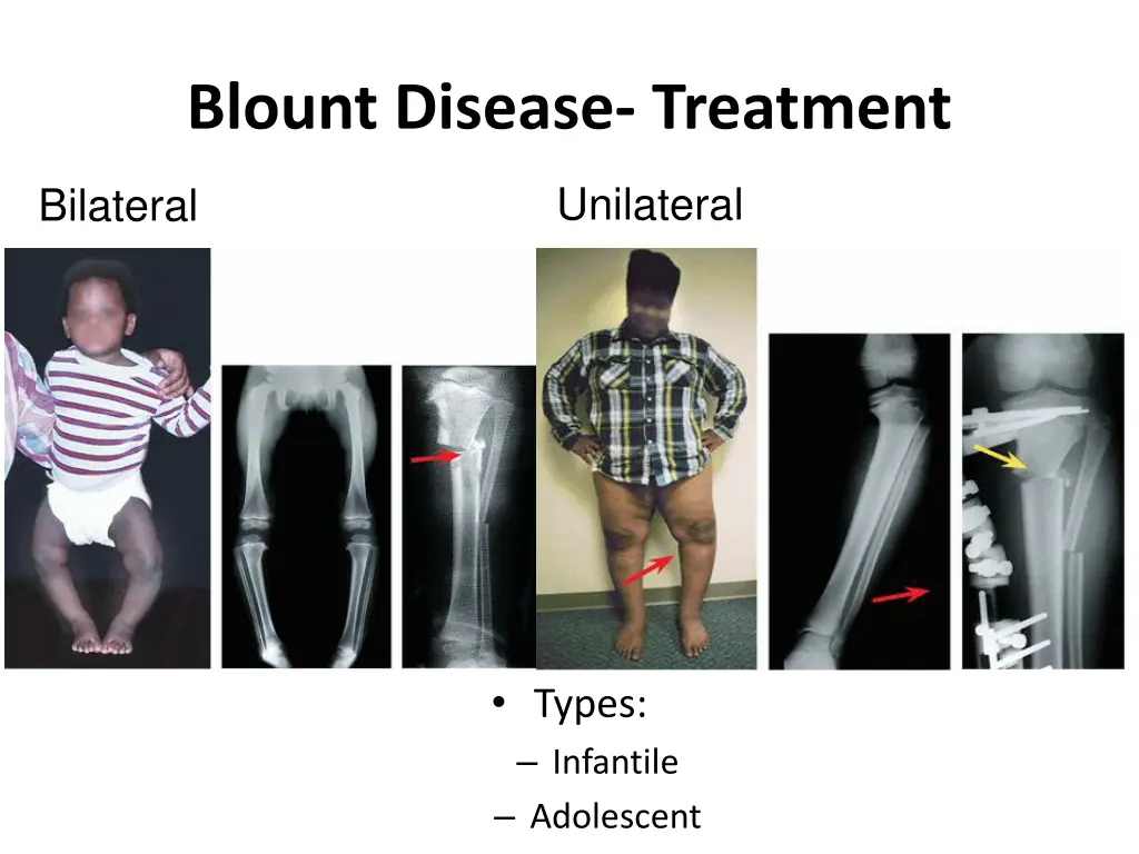 blount disease treatment