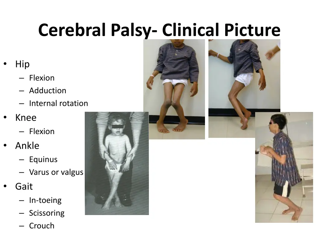 cerebral palsy clinical picture