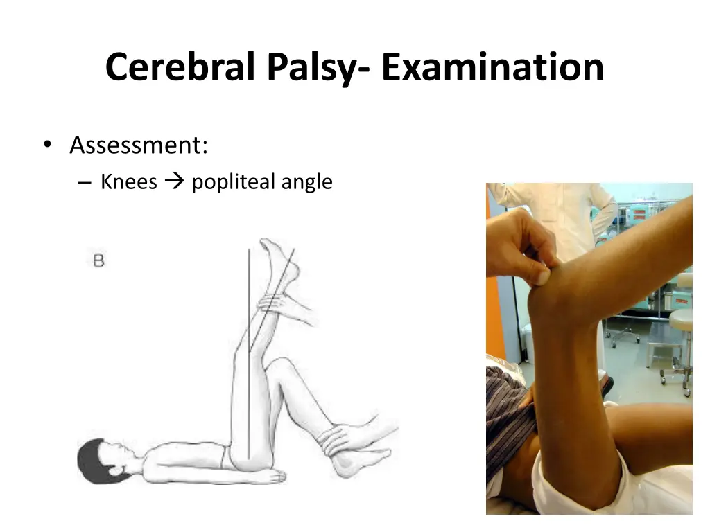 cerebral palsy examination 1