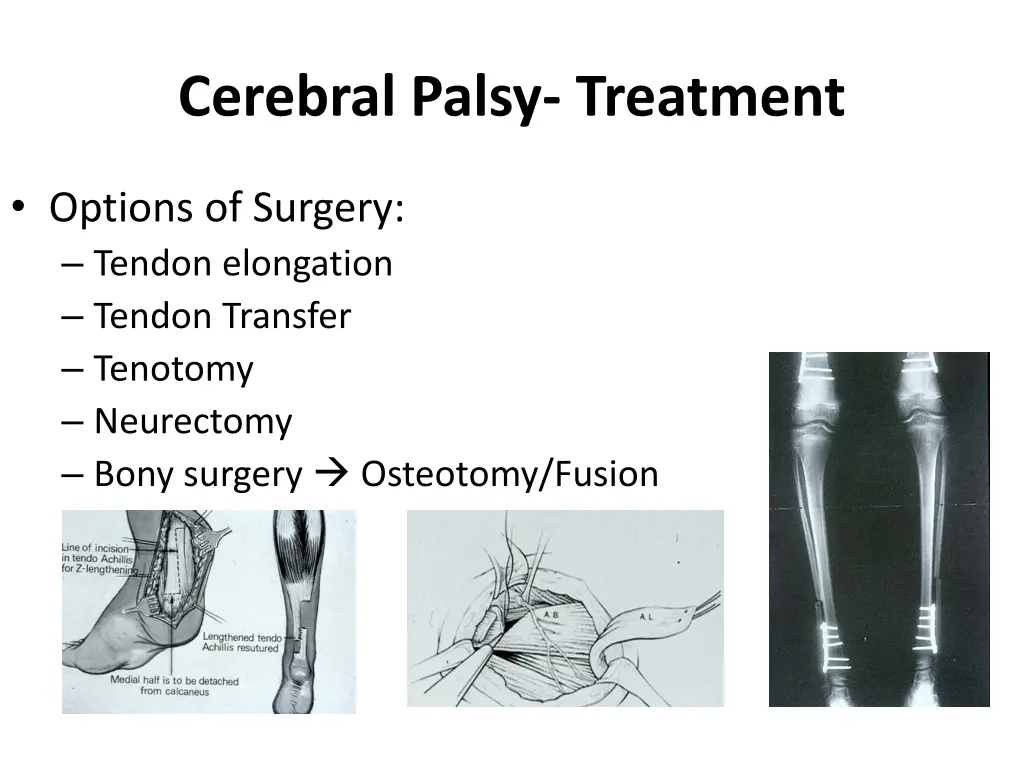 cerebral palsy treatment 5