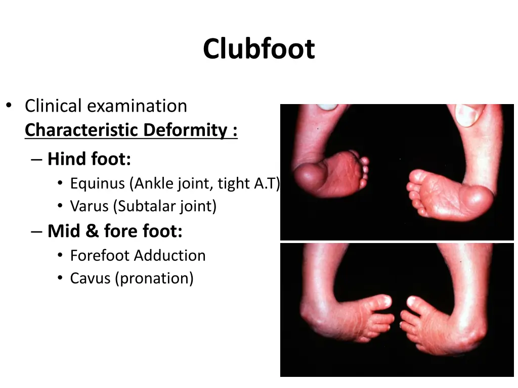 clubfoot 1