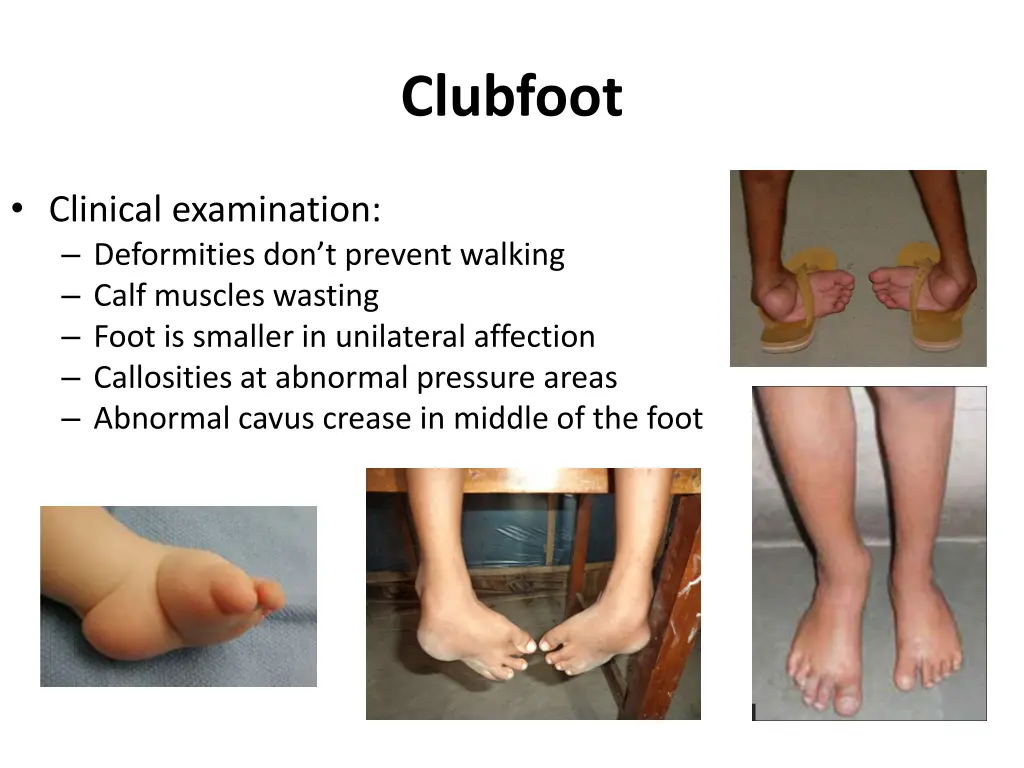 clubfoot 2