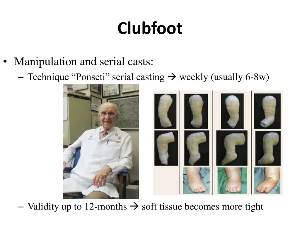 clubfoot 4