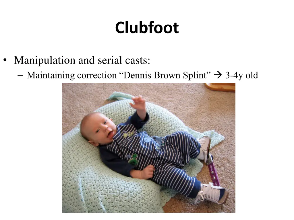 clubfoot 5