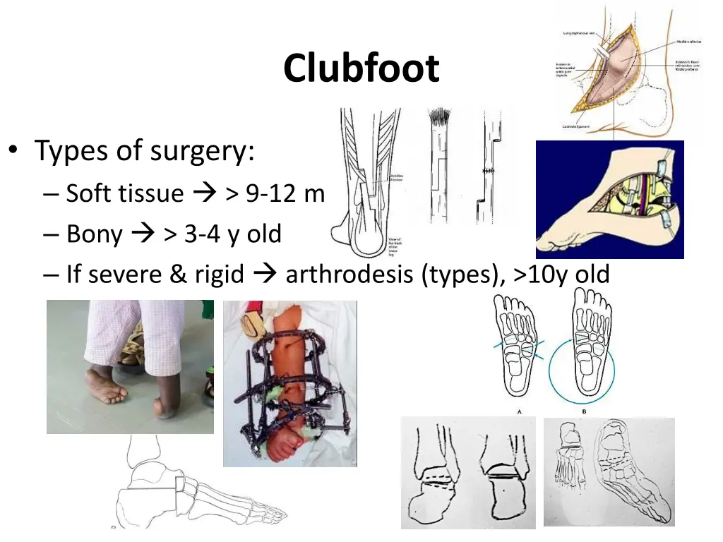 clubfoot 7