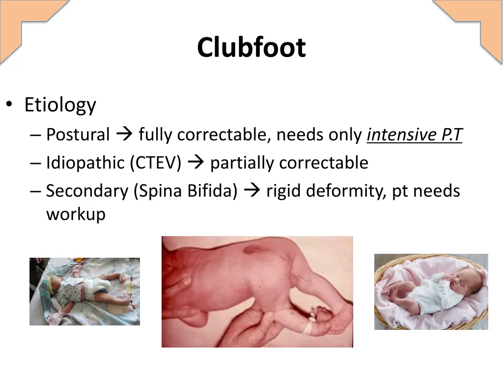 clubfoot