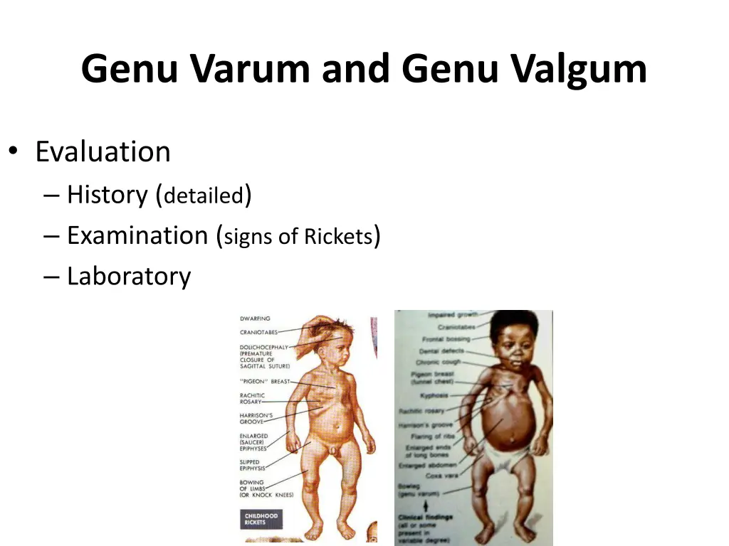 genu varum and genu valgum 2