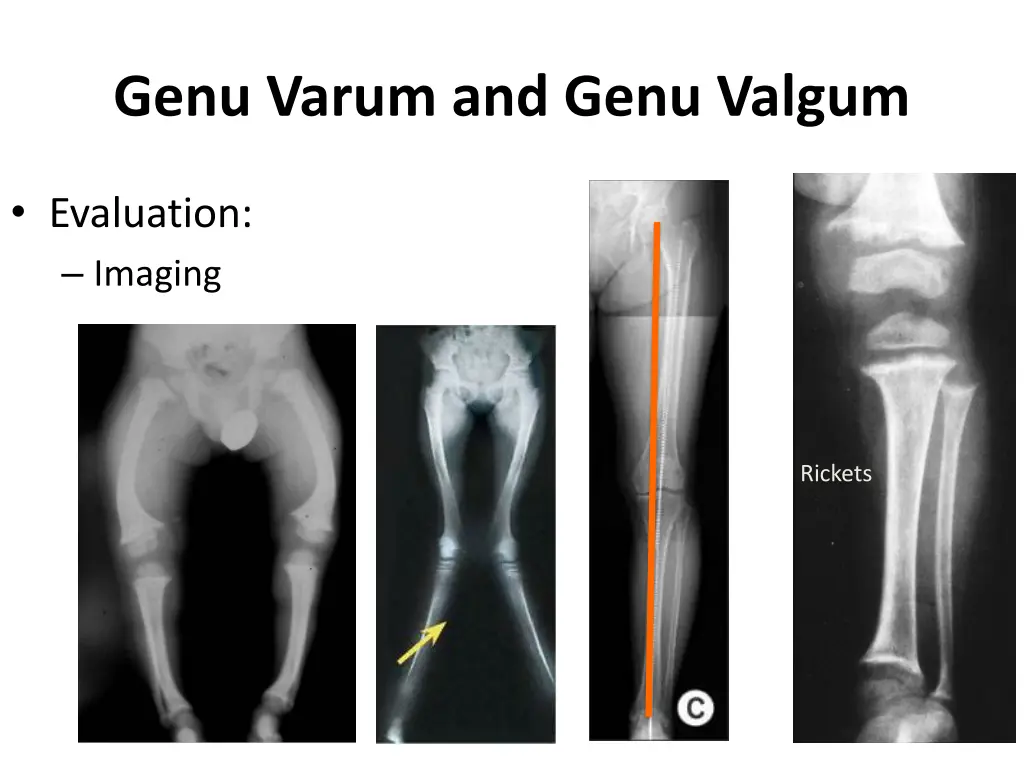 genu varum and genu valgum 3