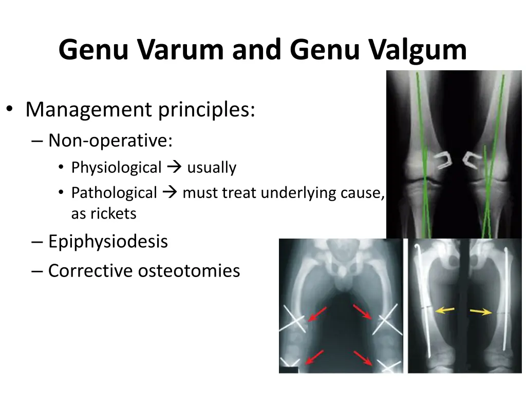 genu varum and genu valgum 4