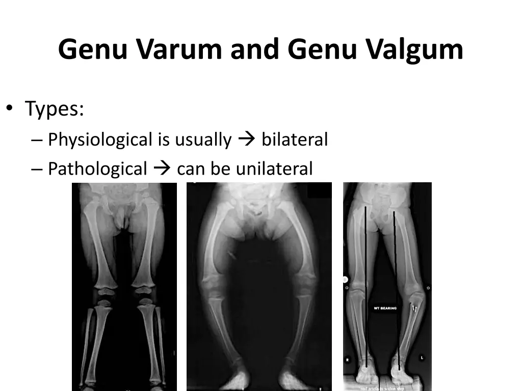 genu varum and genu valgum