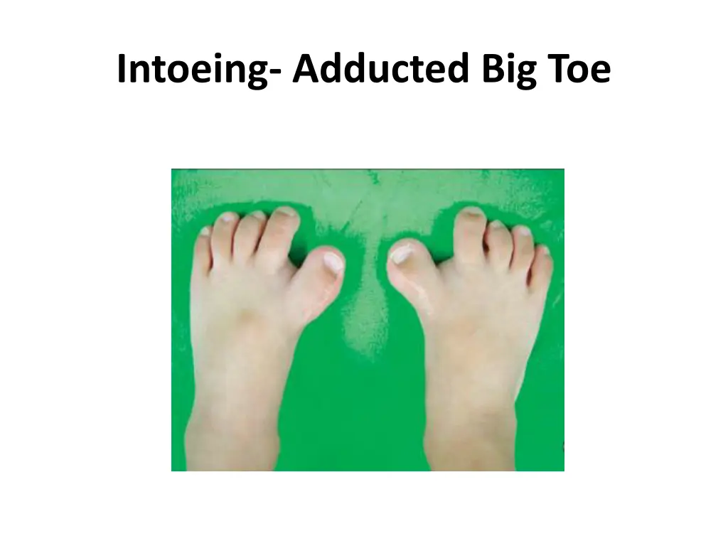 intoeing adducted big toe