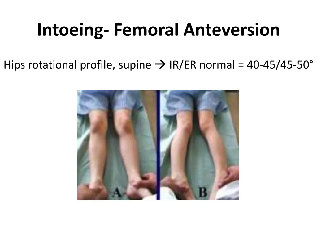 intoeing femoral anteversion