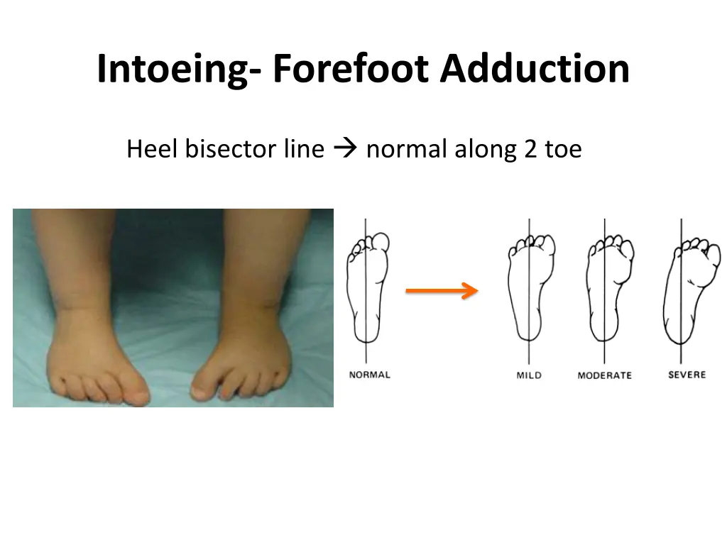 intoeing forefoot adduction