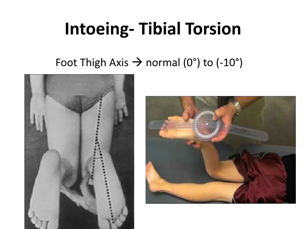 intoeing tibial torsion 1