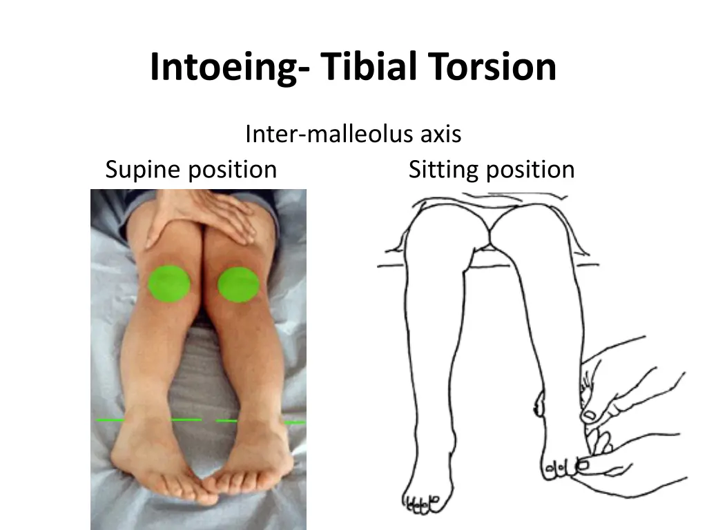 intoeing tibial torsion