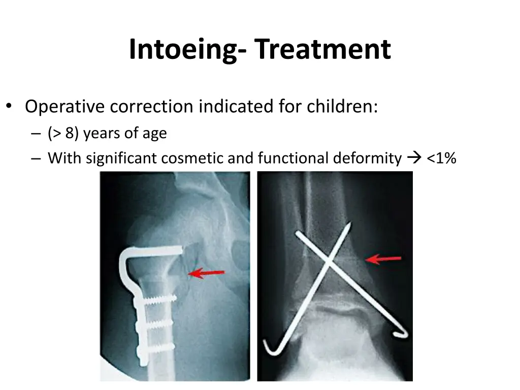 intoeing treatment 1