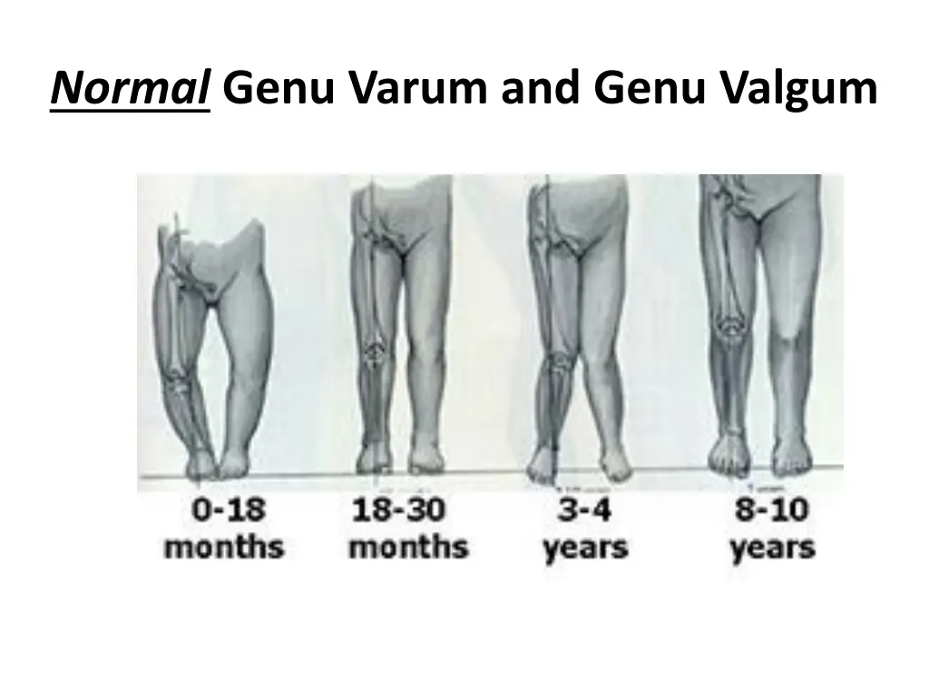 normal genu varum and genu valgum