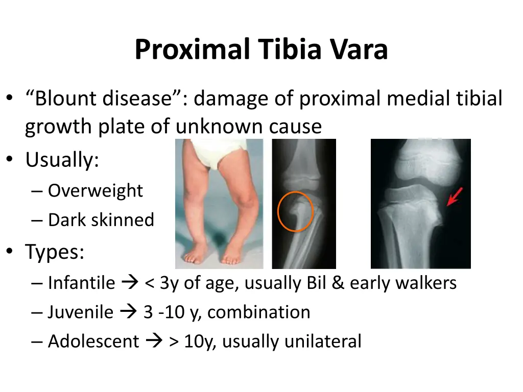 proximal tibia vara 1