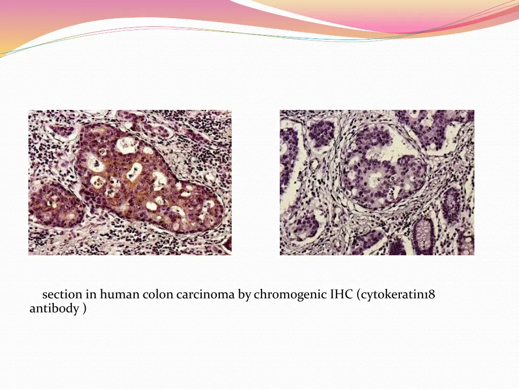 section in human colon carcinoma by chromogenic