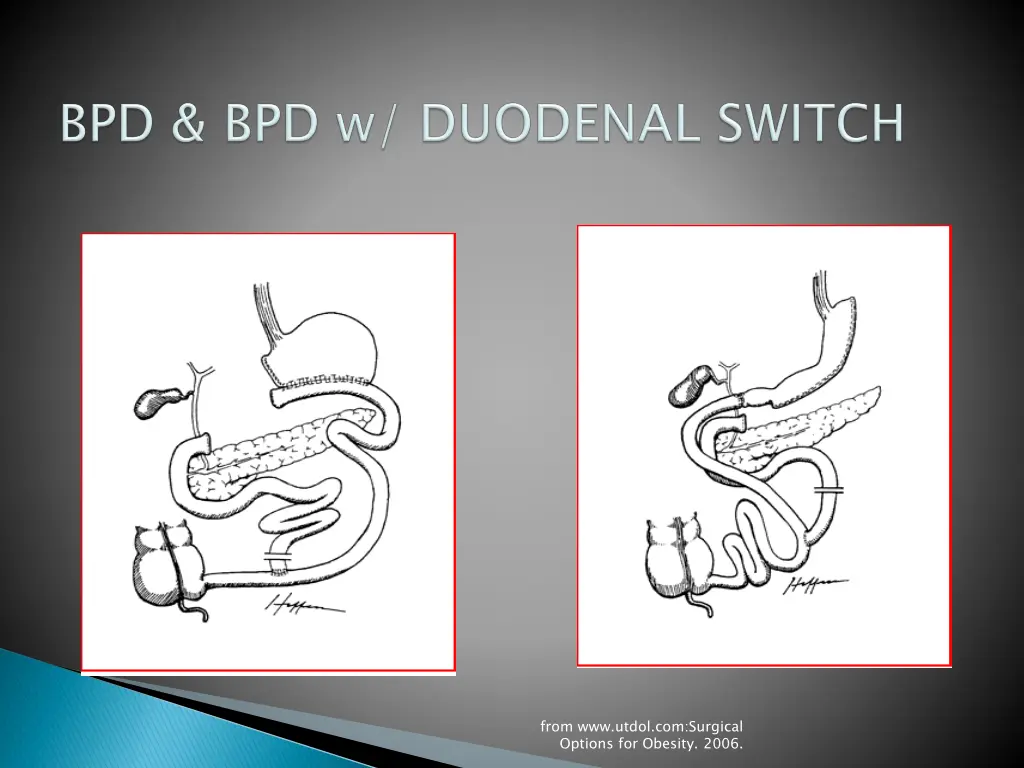 from www utdol com surgical options for obesity