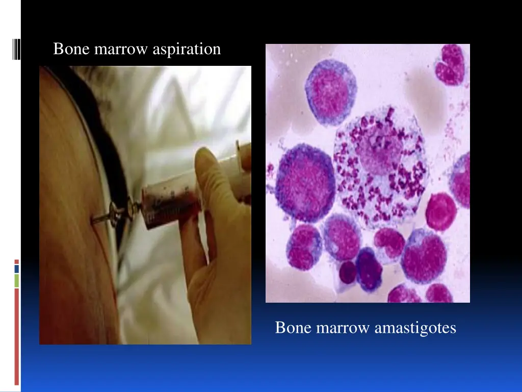 bone marrow aspiration