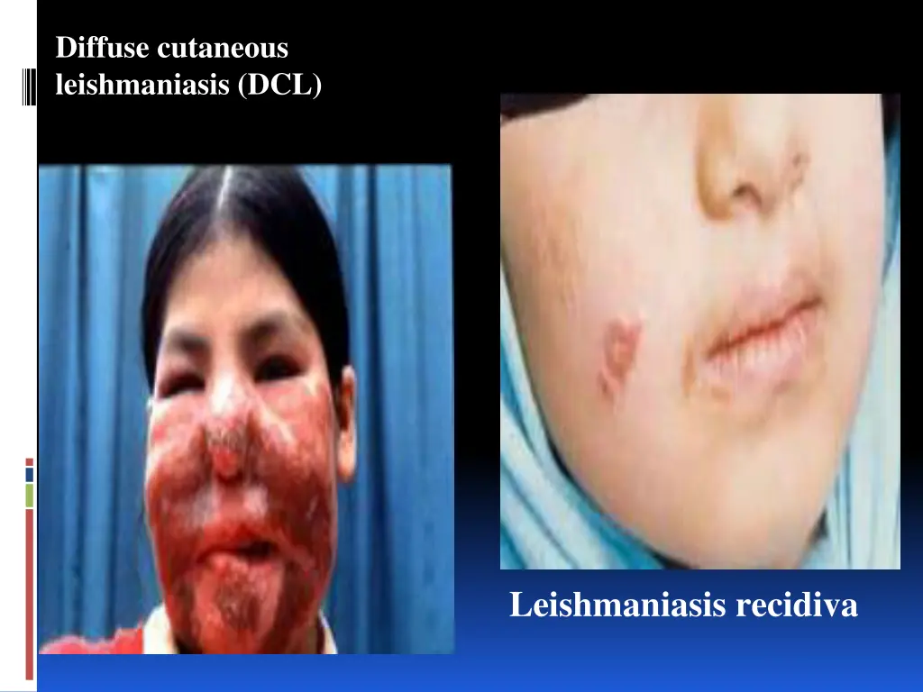 diffuse cutaneous leishmaniasis dcl