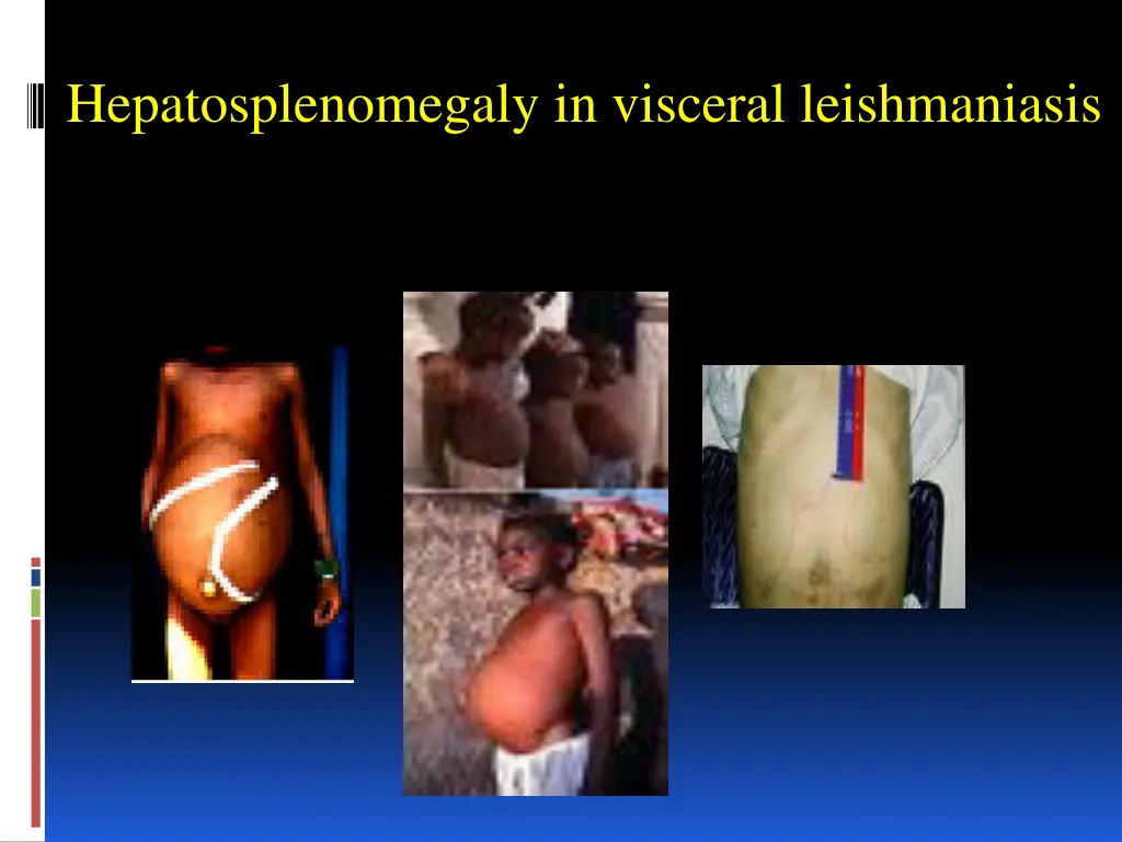 hepatosplenomegaly in visceral leishmaniasis